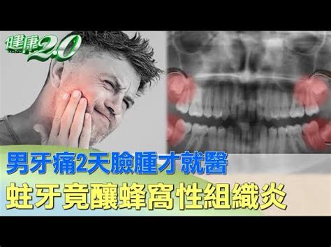 牙痛臉腫怎麼消|牙齒痛臉腫起來怎麼辦？專業牙醫教你如何應對蜂窩性組織炎！